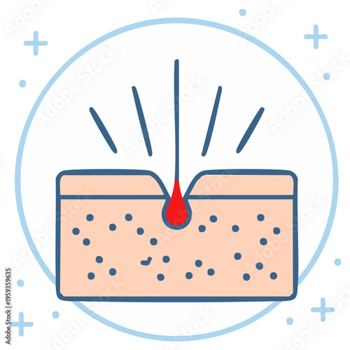Cartoon illustration of inflamed skin pore with blood.