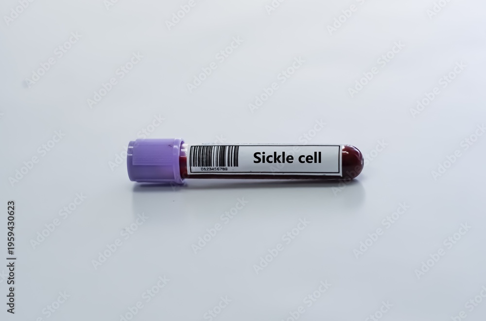 Fototapeta premium Blood sample tube for sickle cell test analysis.