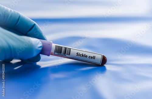 Blood sample tube for sickle cell test analysis.