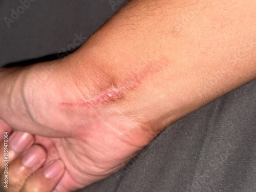 Direct view of a raised pink surgical scar healing on the lower arm and wrist area of a person.