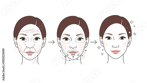 Skincare treatment stages illustration showing a woman's face before and after cosmetic procedures, highlighting wrinkle reduction and skin glow.