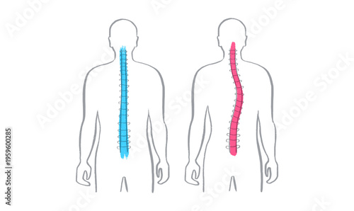 Scoliosis spine deformity