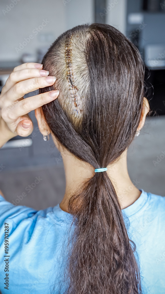 Naklejka premium Close up of surgical scar with staples on shaved head after craniotomy for brain tumor removal. Postoperative care, hygiene and recovery process concept.