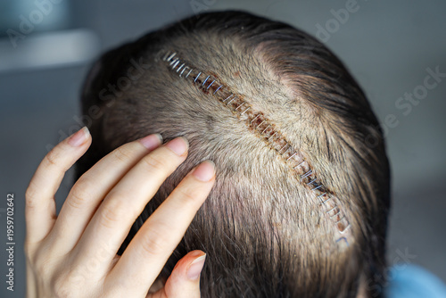 Close up of surgical scar with staples on shaved head after craniotomy for brain tumor removal. Postoperative care, hygiene and recovery process concept.