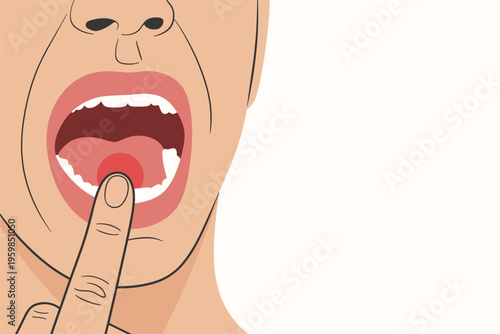 Person pointing to a painful mouth ulcer, medical health concept with copy space