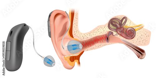 Behind the Ear Hearing Aid Device Medical Illustration with Inner Ear Anatomy. Sound wave transmission from the hearing aid through the middle ear to the inner ear.
