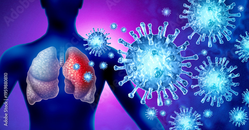 Tableau sur toile HMPV Respiratory Infection as an infectious Virus or Human metapneumovirus as a