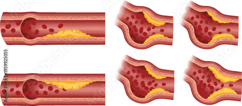 Artery Blockage Vector Illustration with Cholesterol Plaque, Blood Vessel Narrowing and Cardiovascular Disease Concept Collection