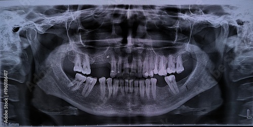 Canvas Print Panoramic X-ray of the jaw of a patient with bad teeth