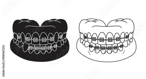Illustration of teeth with braces shown in contrasting black and white