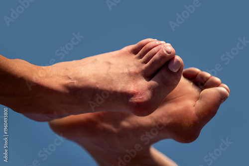 Foto Hallux valgus deformity of big toe joint