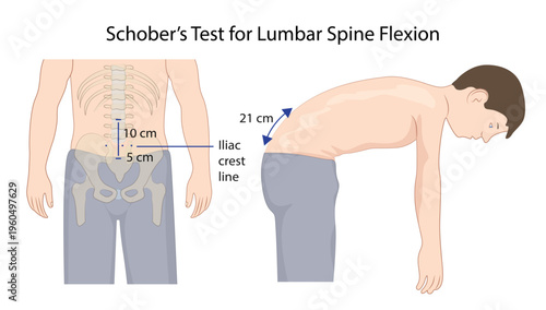 Schober’s Test for Lumbar Spine Flexion, Clinical test measuring lumbar spine flexibility by assessing the increase in distance during forward bending.