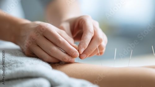 Acupuncturist places needles into patient’s skin during treatment session in clinic