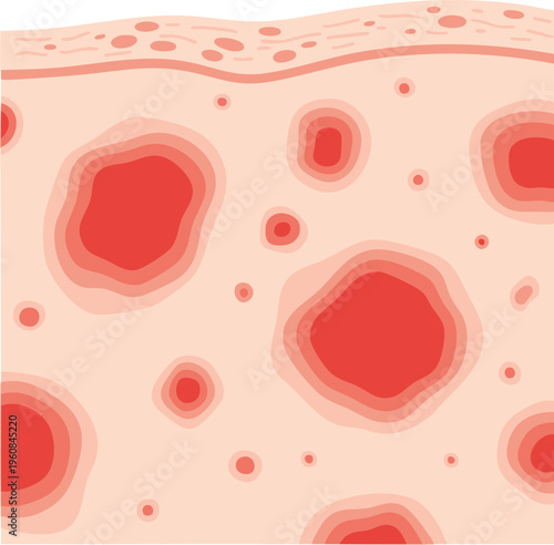 Illustration of skin surface with multiple circular red raised patches and inflamed borders, depicting dermatitis irritation and allergic reaction