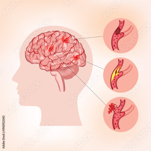 Medical illustration of brain stroke showing blocked and ruptured blood vessels, highlighting ischemic and hemorrhagic stroke conditions in human brain anatomy.