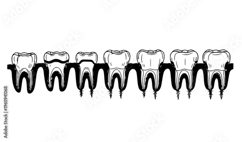 A vector graphic illustration of dental implants and teeth in a row