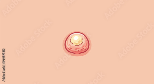 Close-up illustration of a red and inflamed pimple with a yellowish head