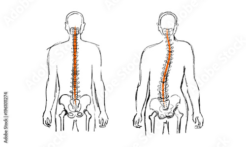 Scoliosis spine deformity