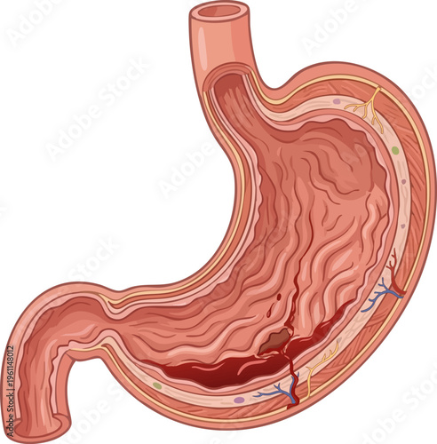 Vector medical illustration of a bleeding gastric ulcer in the human stomach cross section