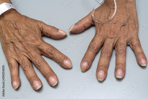 Medical themes: Patiente with nail clubbing from lung cancer disease. Paraneoplastic Syndrome