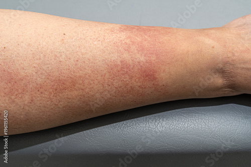 Tableau sur toile Elderly patient with vasculitis in the legs due to an adverse reaction to atenolol