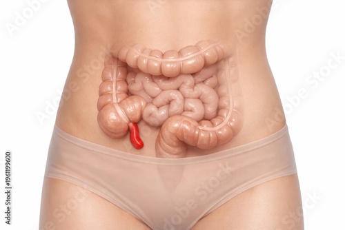 Acute appendicitis medical illustration showing inflamed appendix near cecum with swollen wall in abdominal emergency concept for diagnosis education and surgical pathology care