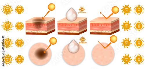 Sunscreen SPF Protection Levels Skin Layers UV Radiation Infographic Illustration. Sun Exposure and SPF Defense Skin Anatomy Comparison Medical Illustration