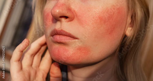 Bild auf Leinwand Rosacea and couperosis of the skin