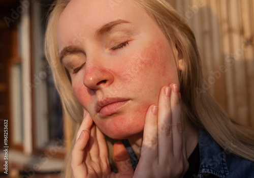Rosacea and couperosis of the skin. The girl suffers from redness on her cheeks or sunburn symptoms. Redness and capillary mesh are visible on the face. Vascular surgery and dermatology