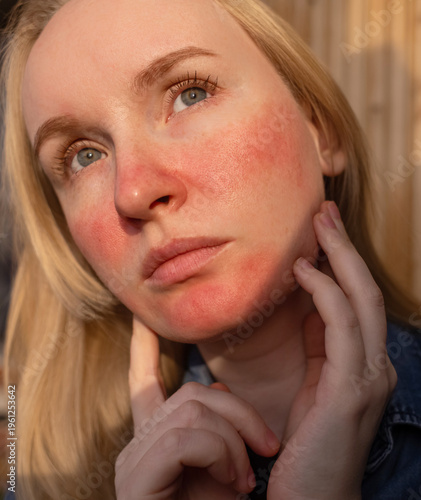 Rosacea and couperosis of the skin. The girl suffers from redness on her cheeks or sunburn symptoms. Redness and capillary mesh are visible on the face. Vascular surgery and dermatology