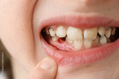 Close up shows child smile with fresh gap after baby tooth loss, small blood spot and orthodontic appliance during tooth change.