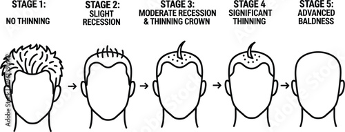 Man hair loss stages balding process from full hair to complete baldness