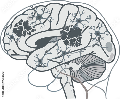Illustration of a brain with dark degenerative spots and damaged neurons, highlighting atrophy and cell loss in Huntington’s disease