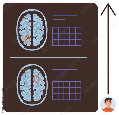 Medical research, neurology, healthcare diagnostics, brain disorders, scientific study, medical training. Two brain scan images with marked abnormalities and data charts. Medical research