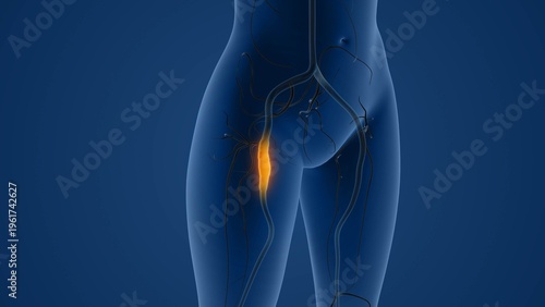 Cuadro en lienzo Claudication due to peripheral artery disease