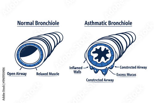 A medical illustration comparing the anatomy of a normal bronchiole to an asthmatic bronchiole Vector