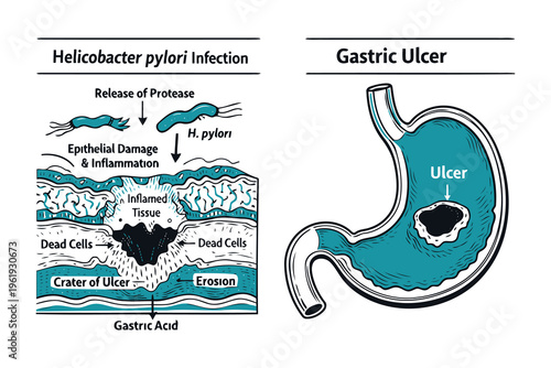 A medical diagram illustrating the progression of helicobacter pylori infection to gastric ulcer Vector