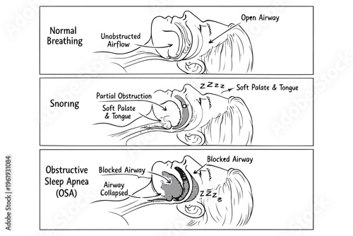 A medical illustration comparing normal breathing, snoring, and obstructive sleep apnea conditions Vector