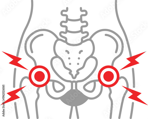 Vector graphic illustration of human pelvis with highlighted hip joint pain points and red lightning bolts indicating discomfort