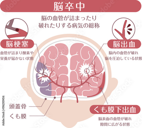 Stroke Types Medical Illustration