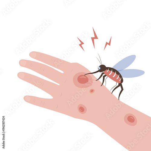 Mosquito bite on skin hand human. Insect bites man in arm. Dangers Zika virus. Drinks the blood. Bloodsucking pest. Design isolated on background. Malaria epidemic.