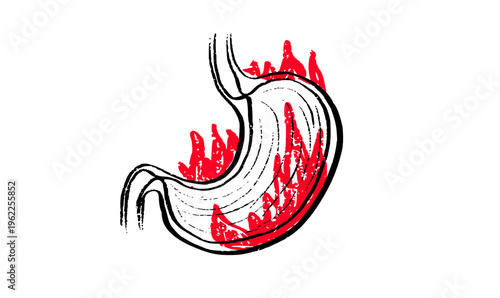 Gastroesophageal reflux pain