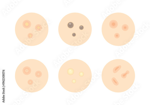 Different types of pimples. Skin problems. Health care. Acne disease.