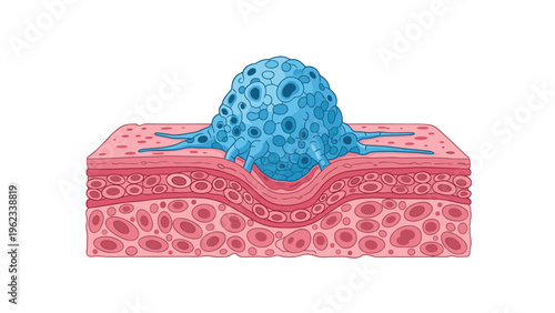 Detailed cross-section of skin reveals a large, aggressively growing cancerous tumor, symbolizing serious skin cancer and oncology.