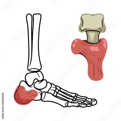 An anatomical illustration of the human foot and ankle bones with heel highlighted, plus a separate bone.
