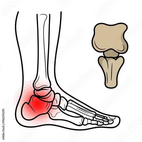 An anatomical illustration of the human foot and ankle bones highlighting a specific red pain point.