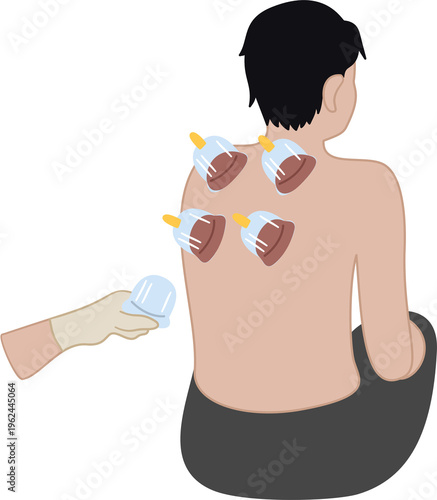 traditional medication treatment bekam