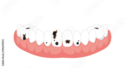 An upper human jaw with white teeth and visible black and brown cavities is depicted on a white background.