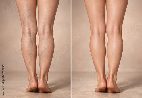 Ultra-realistic medical before-and-after visualization of sclerotherapy treatment for varicose veins on female legs.