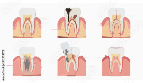 Dental problems educational diagram vector set
